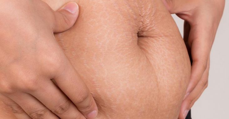 rozstępy po ciąży