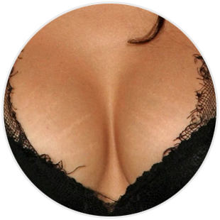 Rozstępy na piersiach